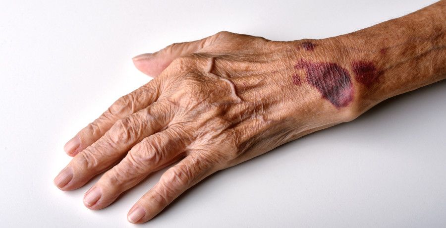 Geprellte Hand eines älteren Menschen. iStockphoto, Artfully79